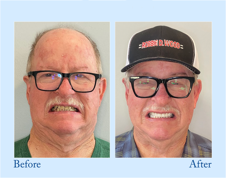 Smileasego™ - Premium Denture