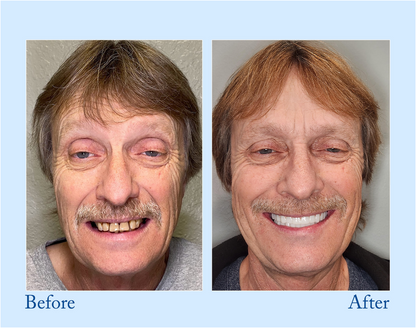 Smileasego™ - Premium Denture